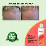 Anti Scaling Scalp Shampoo Dry Scalp Dandruff Medicated Shampoo 200ml