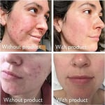 Science of Skin Rescue No. One Acne/Rosacea Scar Cream - Acne Scar Treatment For