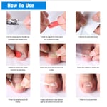 10x/Box Toenail Correction Ingrown Sticker Patch Toe Nail Fixer Recover Ped