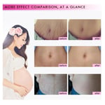 30ml Stretch Mark Essential Oil Scars Prevention Stretch Mark Removal Oil