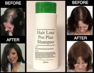 Hair Loss Pro Plus® STIMULATING HAIR LOSS REGROWTH SHAMPOO 300ml FREE P&P