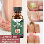 30ml Fungal Nail Repair Essence Care Treatment Whitening Gel Foot Nail