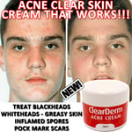 THE NO.1 CLEAR DERM ACNE CREAM, SCARS & BLEMISH CREAM, CLEAR SPOTS